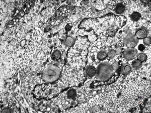 F, 45y. | necrobiosis lipoidica F, 45y. | necrobiosis lipoidica